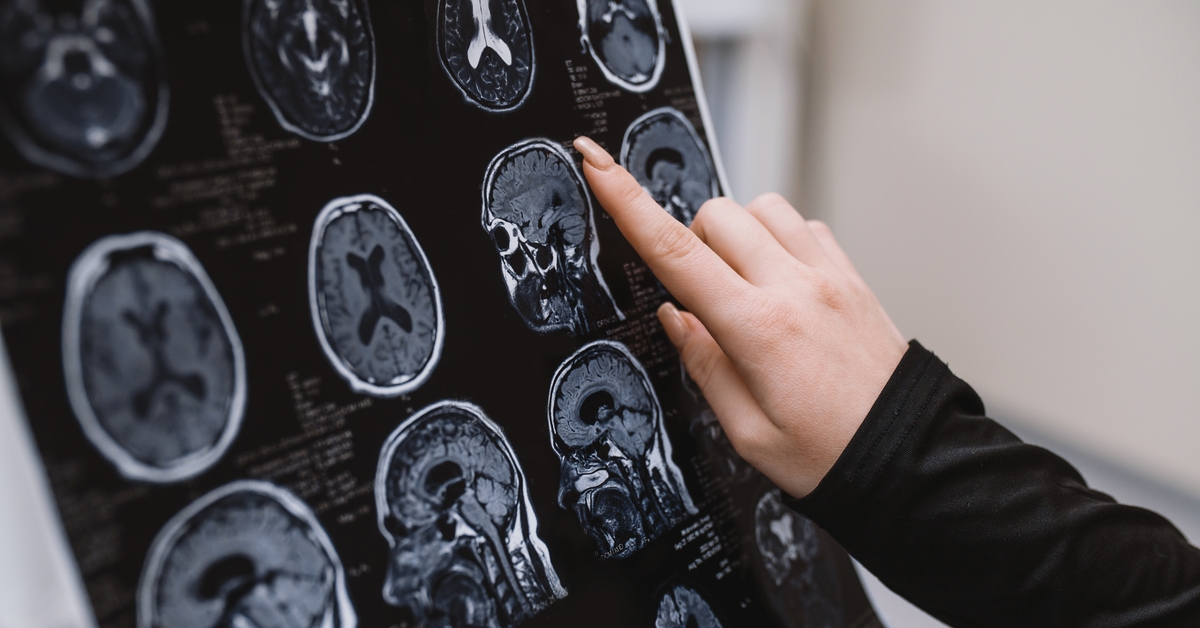 Alzheimer ve Parkinson tedavisinde umut veren gelişme